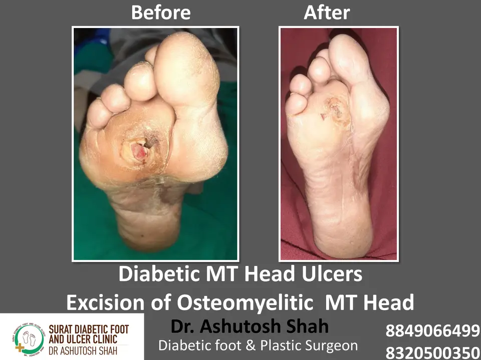 Diabetic Foot  PPT sunita.pptx-31.webp